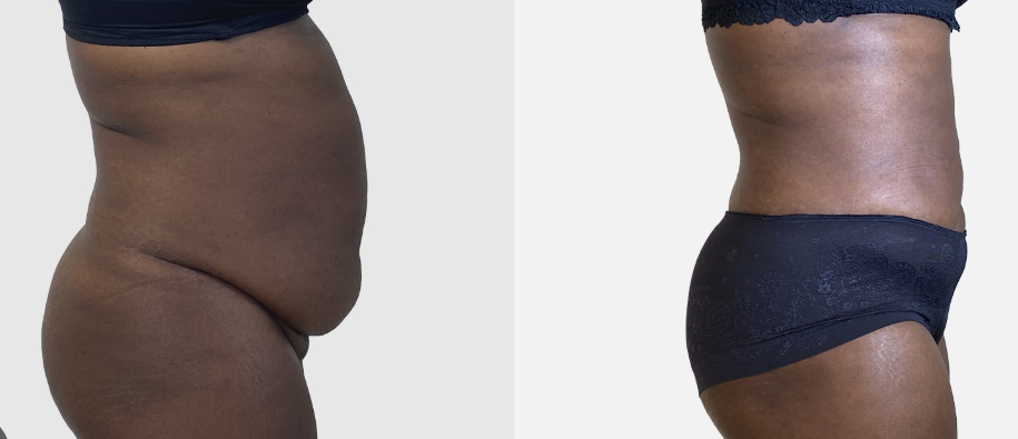 DREN FAST gegen Cellulite mit Equitullas 300ml